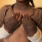 “伊斯兰国”用化学武器攻击后 儿童皮肤碳化(组图)