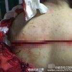 女孩遭陌生男子划伤背部 伤口长32厘米