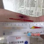 厦一男子被8厘米筷子扎进手臂一个多月没察觉