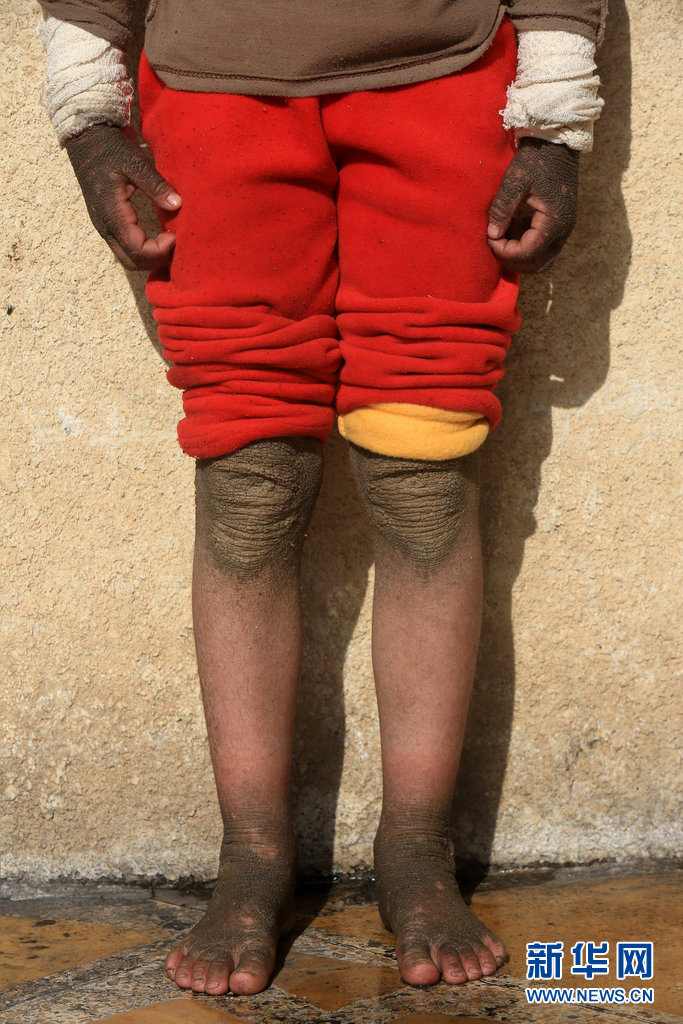 The skin on five-year-old Doaa's legs and arms is blackened after a rocket fired by Islamic State landed and exploded in Qayyara, Iraq, November 12, 2016. REUTERS/Air Jalal